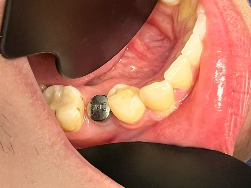 Dental implant procedure step 2 – implant placement and temporary crown attachment