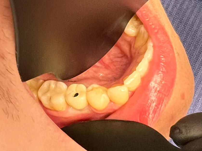 Dental implant step 3 – temporary crown placement during the 3-month healing period)