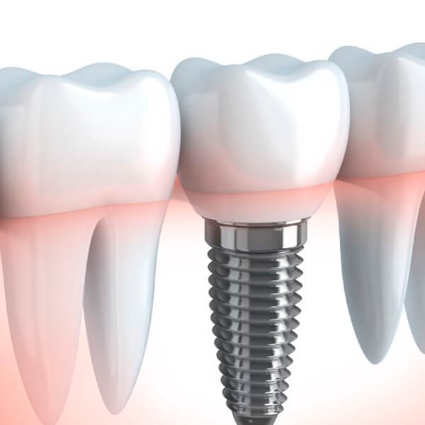 AKCE NA DENTÁLNÍ IMPLANTÁTY