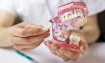  Zubní implantáty All-on-4 a All-on-6