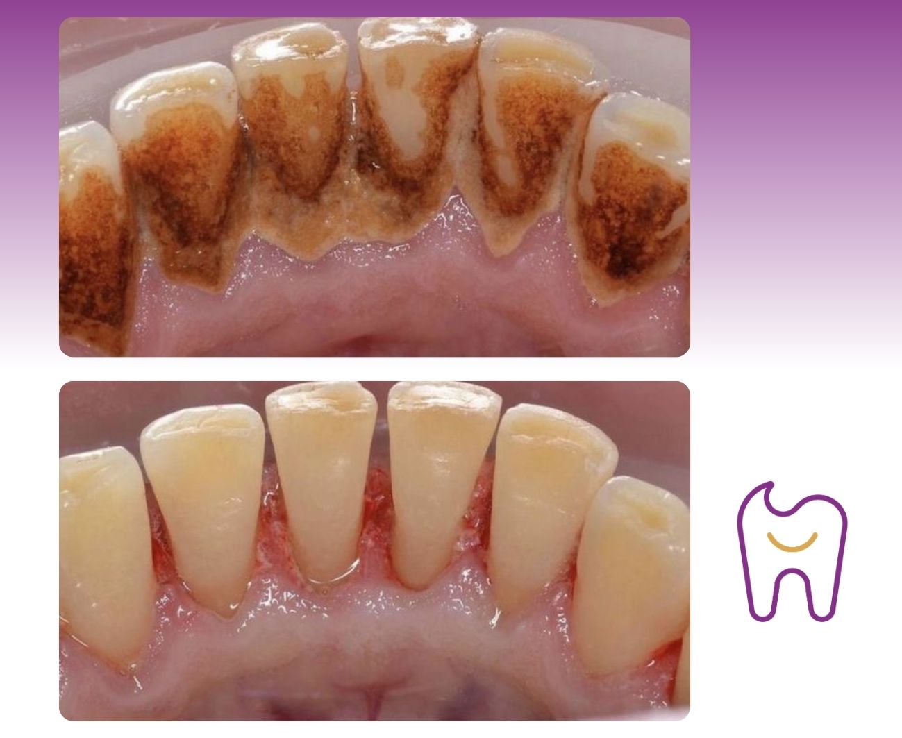 Profesionální dentální hygiena