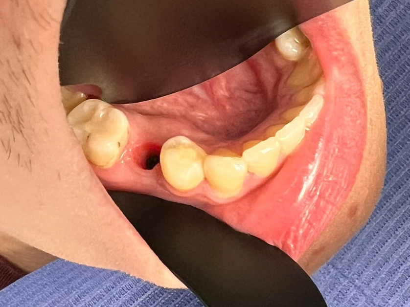 Імплантація зубів крок 1 – підготовка кісткового ложа в яснах Smile Centrum