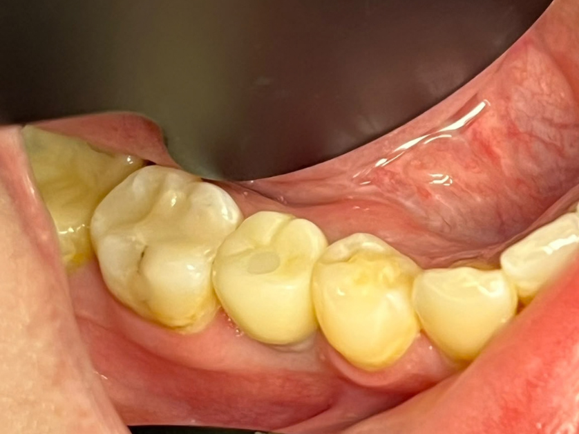 Імплантація зубів крок 5 – фінальна фіксація постійної коронки Smile Centrum