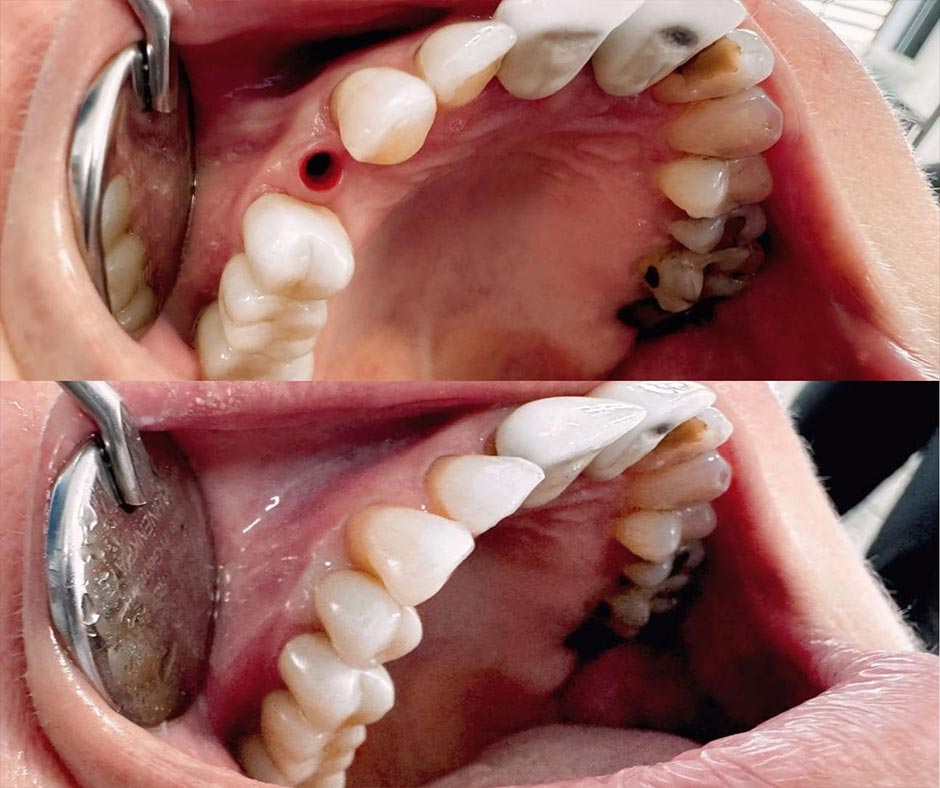 Зубні імплантати: до та після