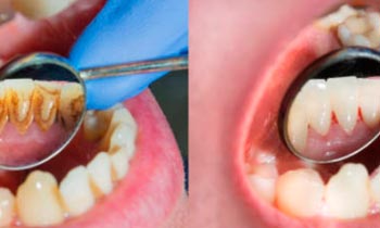 Dental Care for Smokers: komplexní program pro osoby, které kouří
