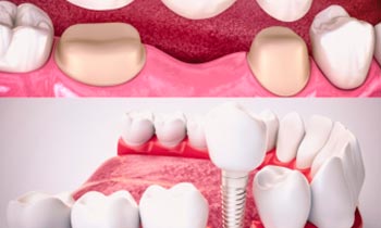 Сo je lepší - můstek nebo implantát?