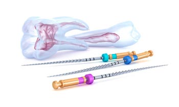 Ošetření kořenových kanálků (endodoncie)