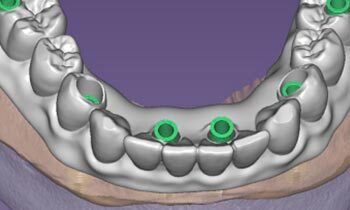 Zubní implantace pomocí chirurgické šablony