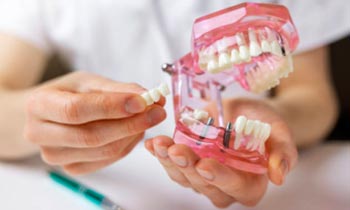 Zubní implantáty All-on-4 a All-on-6