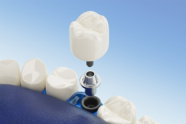Zubní implantáty Smile Centrum Stomatologie