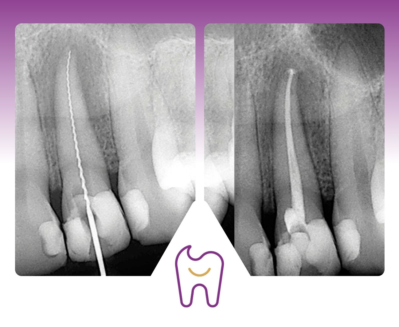 Použití mikroskopu v endodontické léčbě